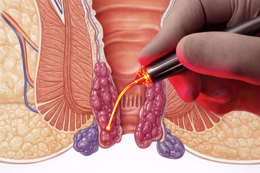 Perianal Crohns Disease