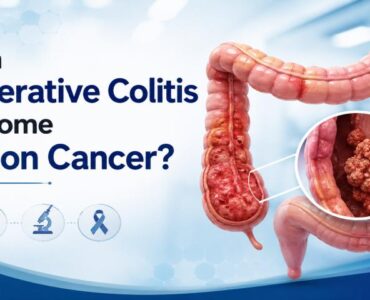 Can ulcerative colitis become colon cancer and increase colon cancer risk