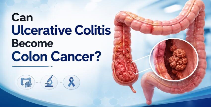 Can ulcerative colitis become colon cancer and increase colon cancer risk